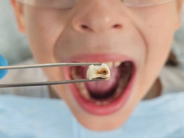 Best Knocked-Out Tooth (Avulsed Tooth) Treatment in New Hope, MS